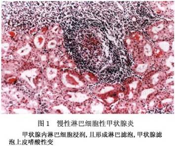 慢性淋巴细胞性甲状腺炎