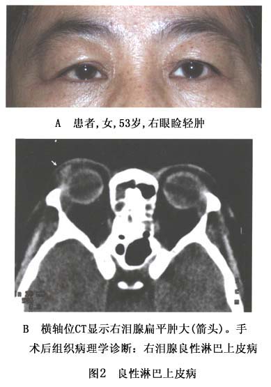 病史为逐渐发生的泪腺肿大,无痛,上睑皮肤肿胀,眼球外上方可扪及肿块