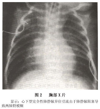 肺间质及肺泡水肿严重时,可产生毛玻璃样改变.