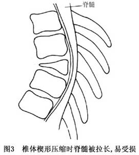 脊柱脊髓伤