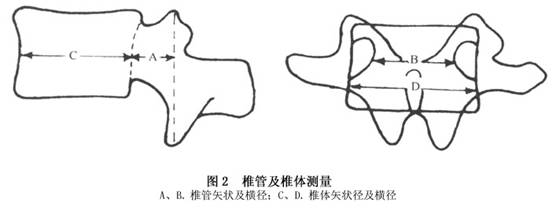 (1)x线平片:在发育性或混合性椎管狭窄者,主要表现为椎管矢状径小