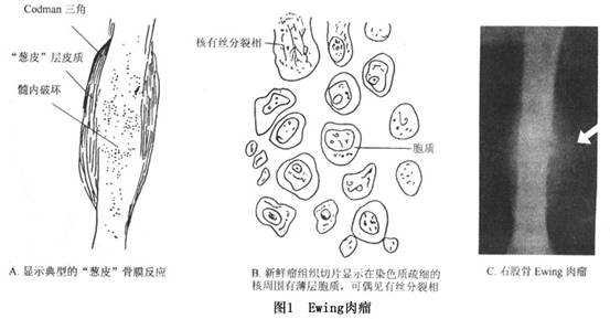 发生于扁骨的尤因肉瘤的x线表现可呈现出溶骨型,硬化型及混合型骨