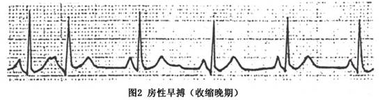 对房性期前收缩典型心电图特点的描述(1)p′波 房性期前收缩的p