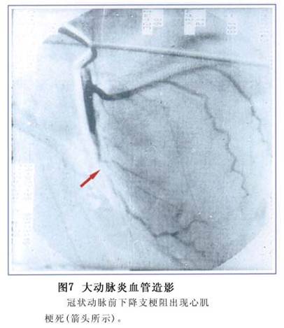 大动脉炎