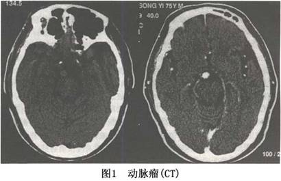 巨大型动脉瘤ct平扫或强化扫描均可发现,表现为动脉瘤周围有脑水肿或