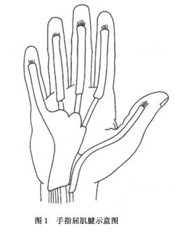 手指屈肌腱鞘炎的发病部位在与掌骨头相对应的指屈肌腱纤维鞘管的