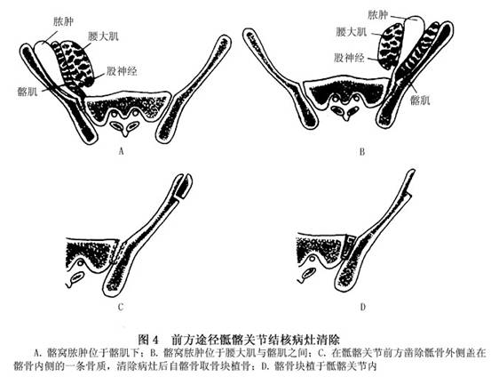 2.前方途径手术  适合前方髂窝有较大脓肿者.