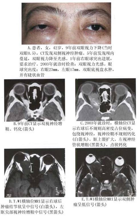 增强mri 脂肪抑制是显示视神经鞘脑膜瘤尤其是怀疑向颅内蔓延的最