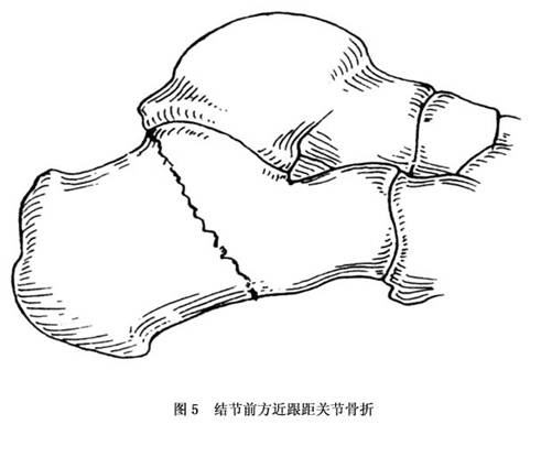 跟骨骨折