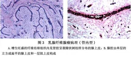 由于上皮下结缔组织从多点突入高度扩张的管腔,又未完全充满后者,故在