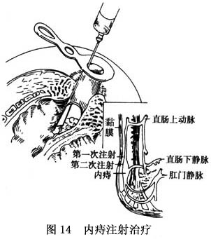 ③方法:注射前嘱病人排空大便,取侧卧位或膝胸位,经斜头或圆头肛门镜