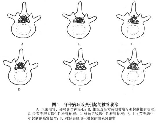 其他原因所致的椎管狭窄     (1)腰椎滑脱,该平面椎管矢状径减小.