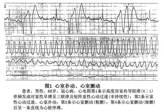 心室扑动典型的心电图特点  连续而规则,宽大,畸形的qrs波,即心室扑动