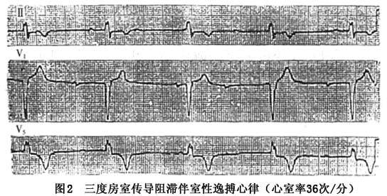 快于心室率是完全性房室传导阻滞所致的完全性房室分离的重要特点之一