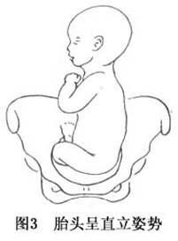 臀位难产(breech presentation)为最常见的异常胎位,占足月分娩总数的