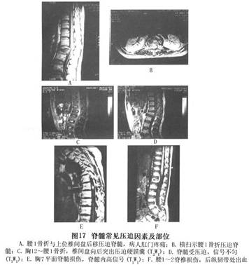 脊柱脊髓伤
