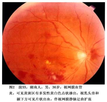 后葡萄膜炎