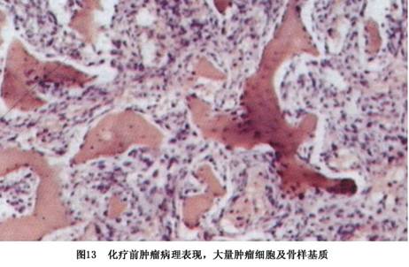 (3)镜下所见:典型骨肉瘤由高度恶性的梭形细胞构成,在肿瘤细胞的