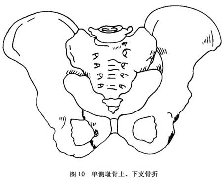 骨盆骨折