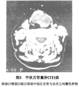 甲状舌管囊肿