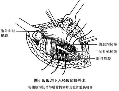 股疝