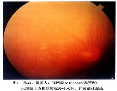 后葡萄膜炎