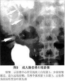 当套叠靠近腹壁或小儿患者肠套叠时,应用5～7.