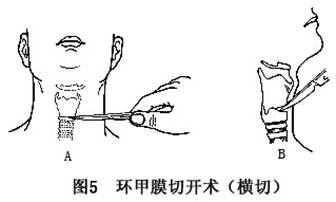 ⑤环甲膜切开:在紧急情况下,也可作环甲膜切开术,插入