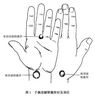 腱鞘囊肿