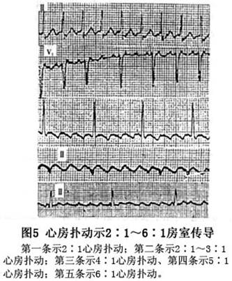 ③3:1房室传导:心房扑动当第1个f波下传时,在房室交接区发生隐匿