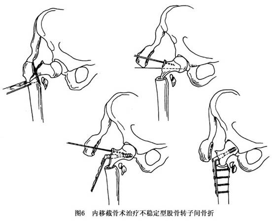 股骨转子间骨折