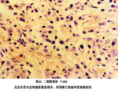 梅毒性关节炎