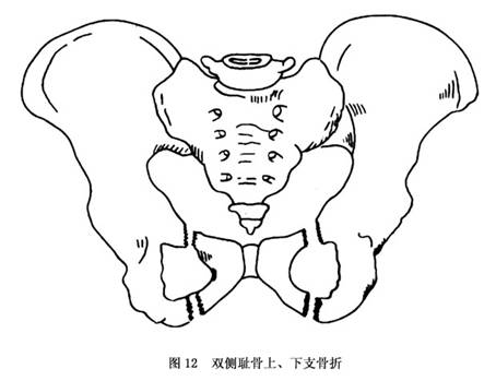 但骨盆后侧仍保持完整,骨折移位不大,对骨盆环的稳定性及承重功能无大