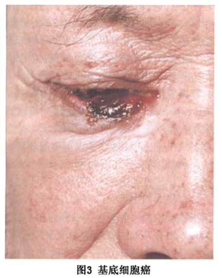 基底细胞癌的疾病介绍 | 微医