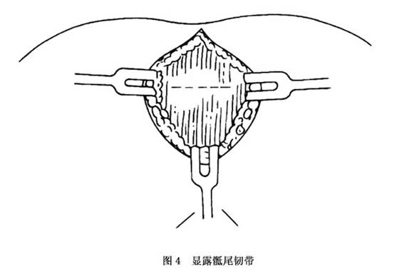 ⑤切除尾骨:由尾骨上端向尾骨尖解剖,用锐刀紧贴尾骨两侧切下附着