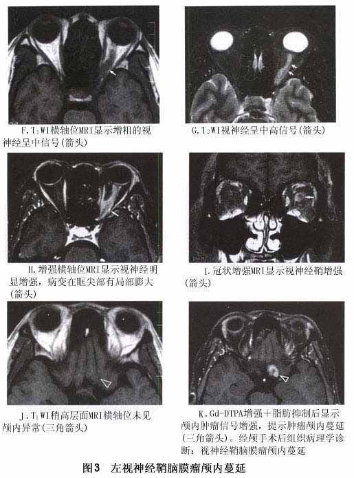 双侧视神经鞘脑膜瘤临床并不少见,应引起临床注意.