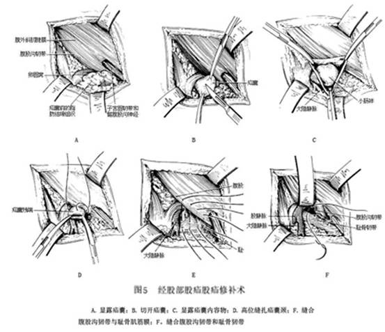 股疝