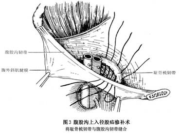 (1)腹股沟上入径(图3):采用斜疝切口,逐层解剖显露腹股沟管后壁,将圆