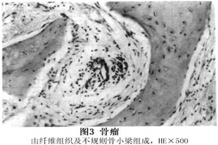 象牙样骨瘤主要由具有少量纤维结缔组织和不规则