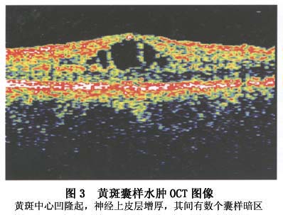 黄斑囊样水肿