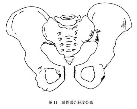 骨盆挤压与分离试验以及"4"字试验均为阳性.