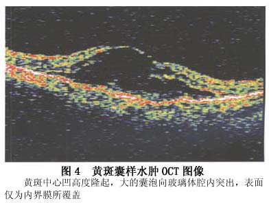 黄斑囊样水肿