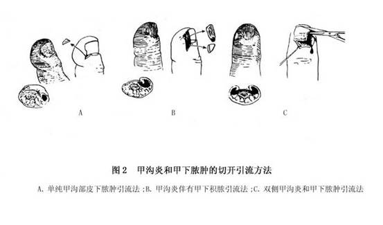 甲沟炎和甲下脓肿