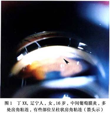 中间葡萄膜炎