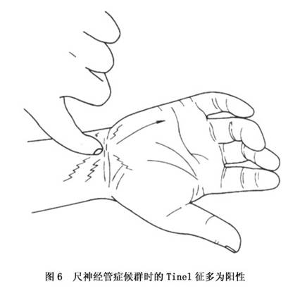 ③对手部内在肌的影响:尺神经严重受累时,常呈典型的"爪形手"(图