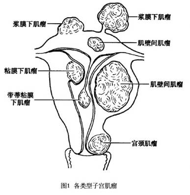 子宫平滑肌瘤