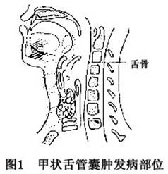 甲状舌管囊肿