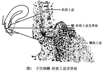 宫颈浸润癌