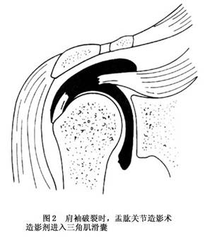 5m距离水平投照时肩峰与肱骨头顶部间距应不小于12mm,如小于10mm,一般