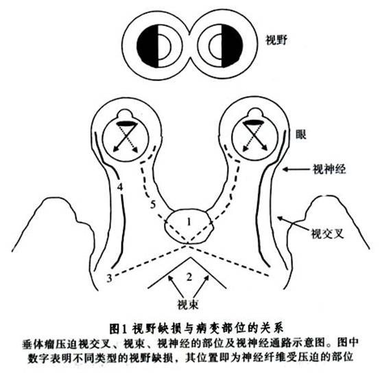 视力减退和视野缺损的出现时间及严重程度不一定平行.